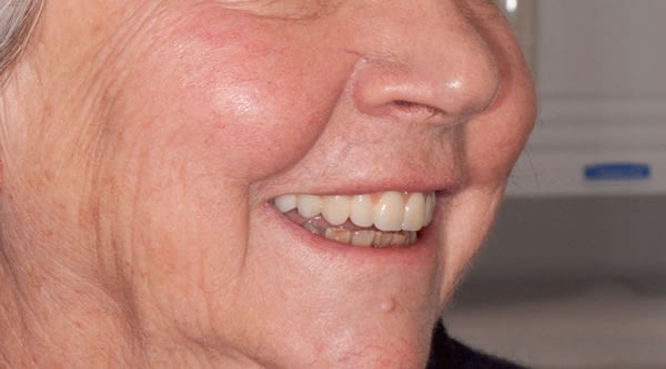 Single Tooth Implant