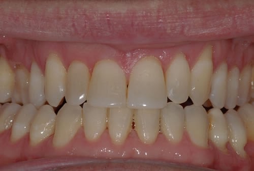 Single Tooth Implant