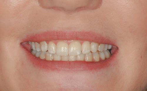 Single Tooth Implant