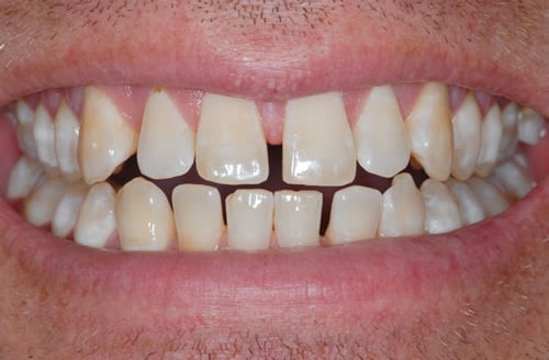 Single Tooth Implant