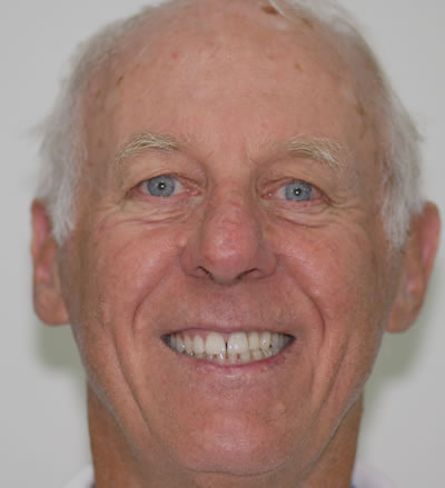 Crowns and Bridges Crowns and Bridges | Jacaranda Dental