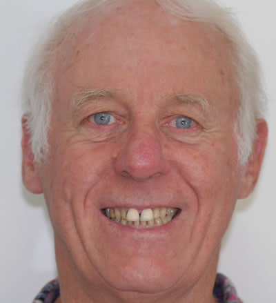 Crowns and Bridges Crowns and Bridges | Jacaranda Dental