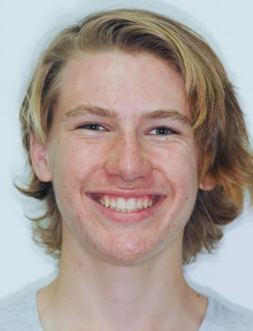 Braces - Orthodontics Braces - Orthodontics | Jacaranda Dental