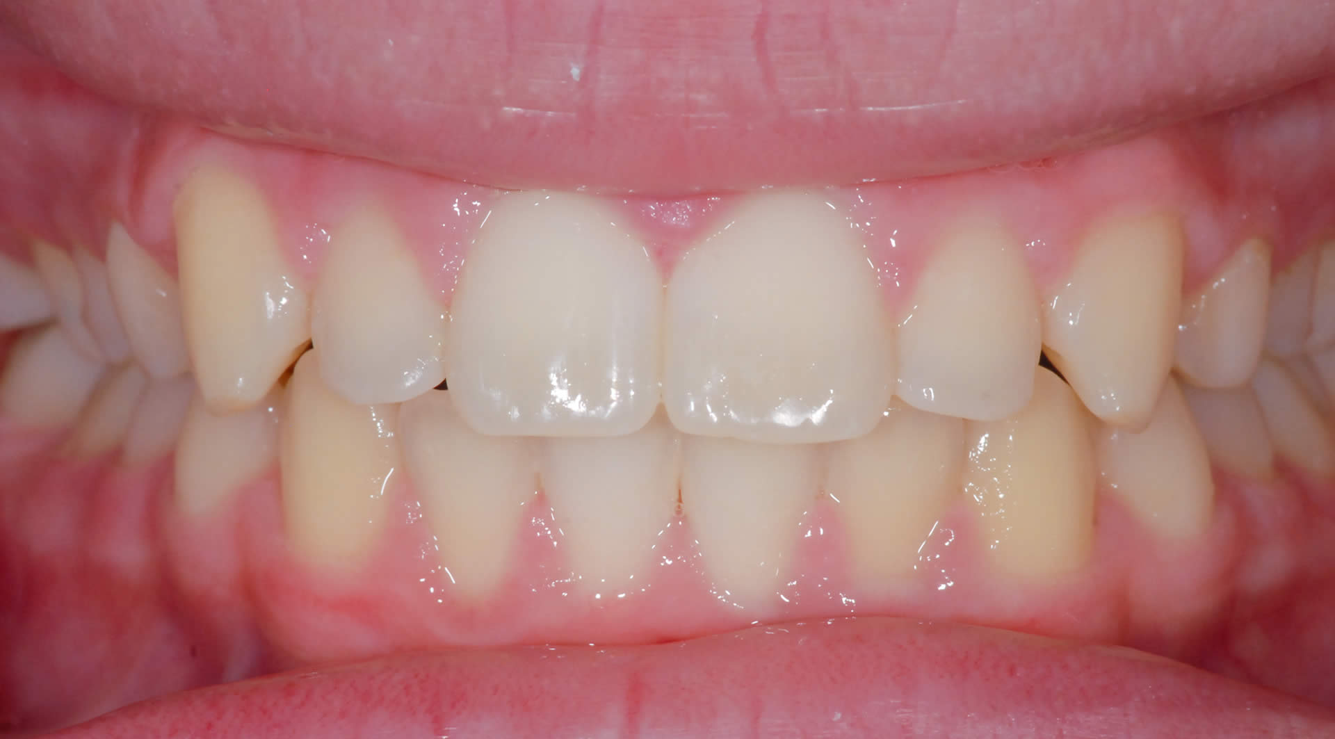 Braces - Orthodontics Braces - Orthodontics | Jacaranda Dental