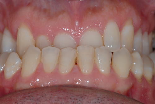 Single Tooth Implant Braces - Fred | Jacaranda Dental