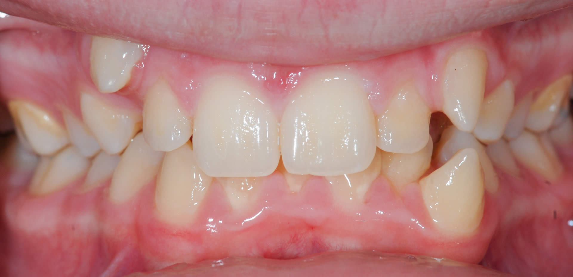 Braces - Orthodontics Braces - Orthodontics | Jacaranda Dental