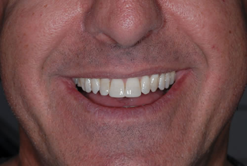 Braces - Fred Braces - Fred | Jacaranda Dental