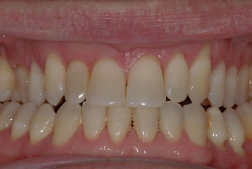 Single Tooth Implant Braces - Fred | Jacaranda Dental