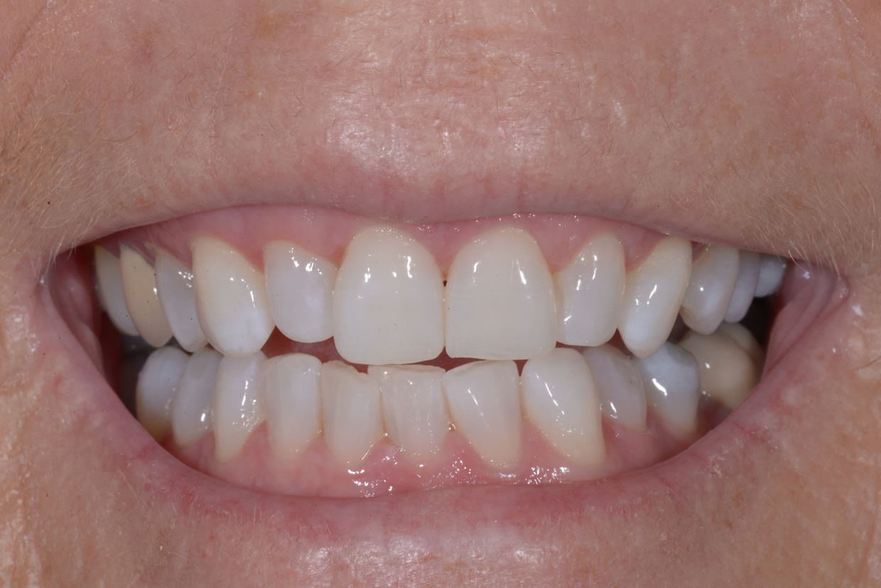 Post-whitening-smile Teeth Whitening | Jacaranda Dental