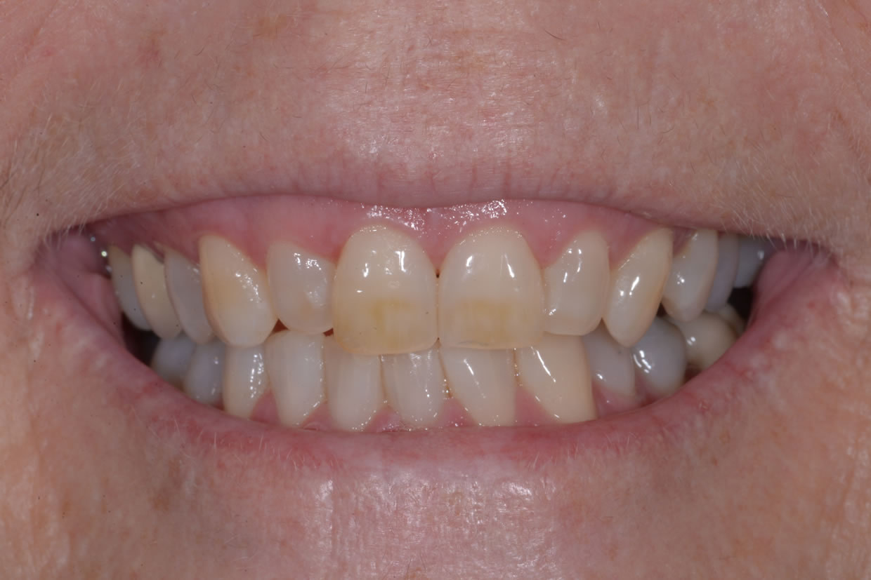 Post-whitening-smile Teeth Whitening | Jacaranda Dental