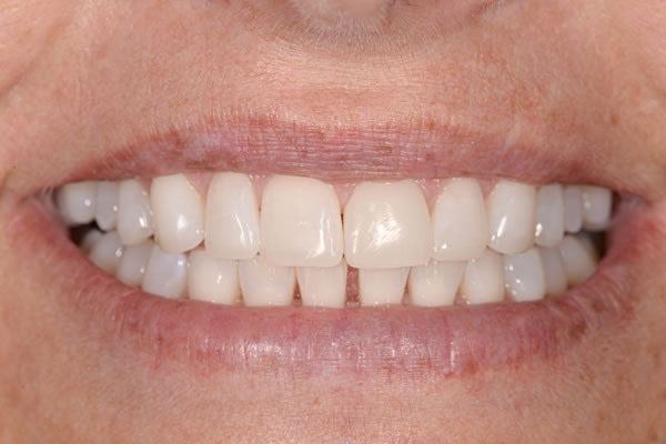 Bite Reconstuction - Sue Bite Reconstuction - Sue | Jacaranda Dental