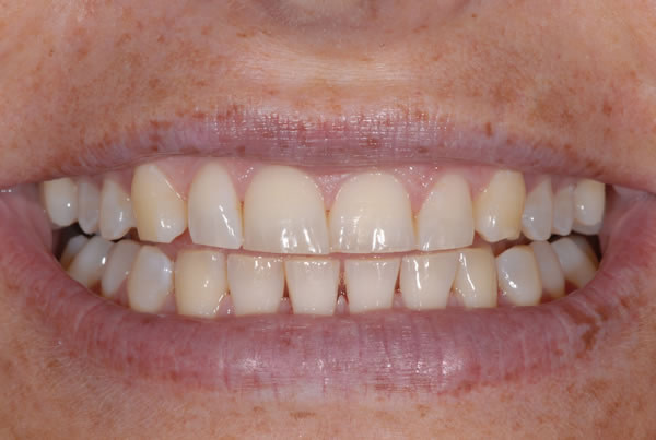 Bite Reconstuction - Sue Bite Reconstuction - Sue | Jacaranda Dental