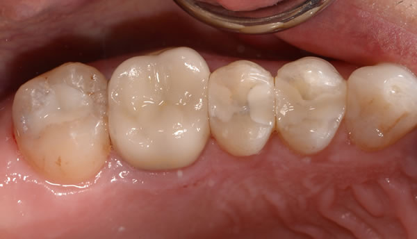 Fillings and Root Canal Treatment | Jacaranda Dental