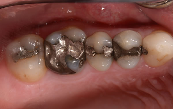 Fillings and Root Canal Treatment | Jacaranda Dental