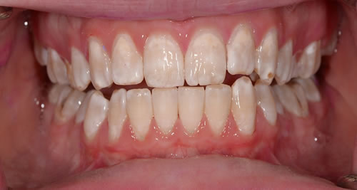 Airflow, Dental Hygiene Angela Airflow, Dental Hygiene Angela | Jacaranda Dental