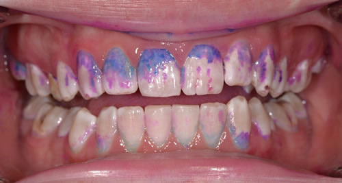 Airflow, Dental Hygiene Angela Airflow, Dental Hygiene Angela | Jacaranda Dental