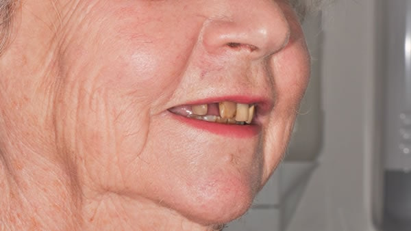 Single Tooth Implant Dental Implants - Sue | Jacaranda Dental