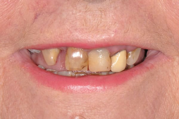 Dental Implants - Sue Dental Implants - Sue | Jacaranda Dental