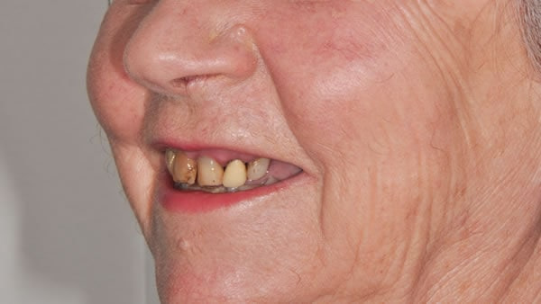 Dental Implants - Sue Dental Implants - Sue | Jacaranda Dental