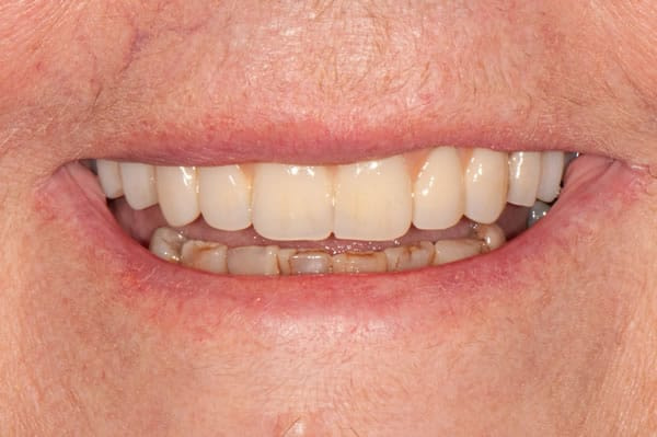 Dental Implants - Sue Dental Implants - Sue | Jacaranda Dental
