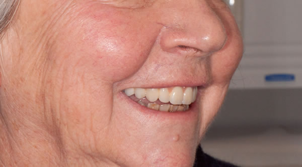 Single Tooth Implant Dental Implants - Sue | Jacaranda Dental
