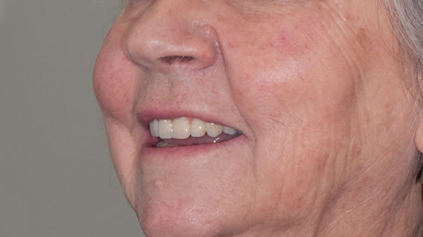 Dental Implants - Sue Dental Implants - Sue | Jacaranda Dental