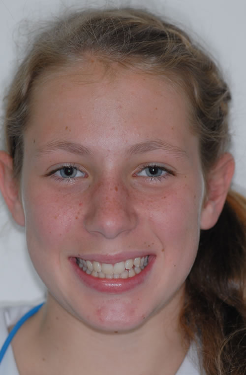 Fixed Braces - Sophie Fixed Braces - Sophie | Jacaranda Dental