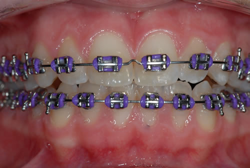 Fixed Braces - Sophie Fixed Braces - Sophie | Jacaranda Dental
