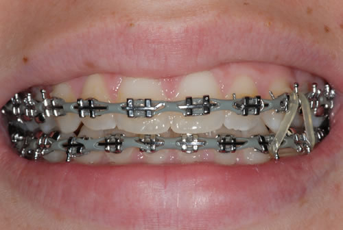 Fixed Braces - Sophie Fixed Braces - Sophie | Jacaranda Dental
