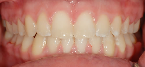 Fixed Braces - Sophie Fixed Braces - Sophie | Jacaranda Dental