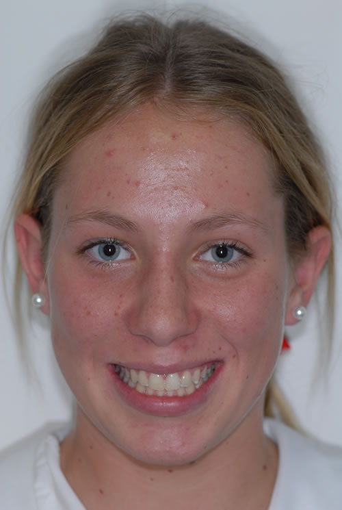 Fixed Braces - Sophie Fixed Braces - Sophie | Jacaranda Dental