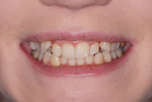 Single Tooth Implant Invisalign - Kristy | Jacaranda Dental