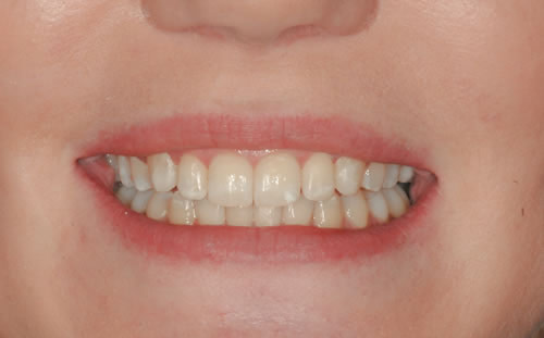 Single Tooth Implant Invisalign - Kristy | Jacaranda Dental