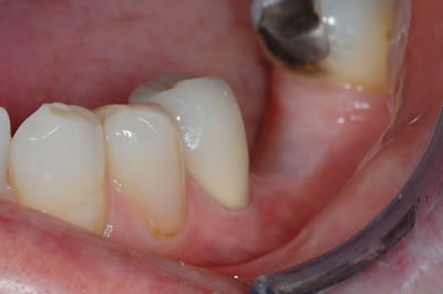 Crowns and Bridges Crowns and Bridges | Jacaranda Dental