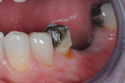 Crowns and Bridges Crowns and Bridges | Jacaranda Dental