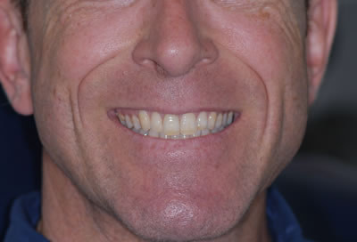 Crowns and Bridges Crowns and Bridges | Jacaranda Dental