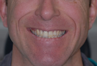 Crowns and Bridges Crowns and Bridges | Jacaranda Dental