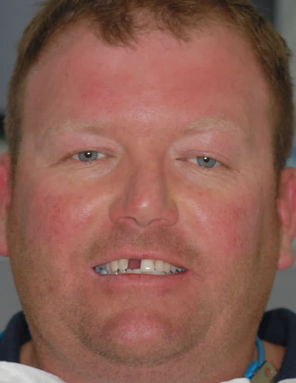 Dental Implants Dental Implants | Jacaranda Dental