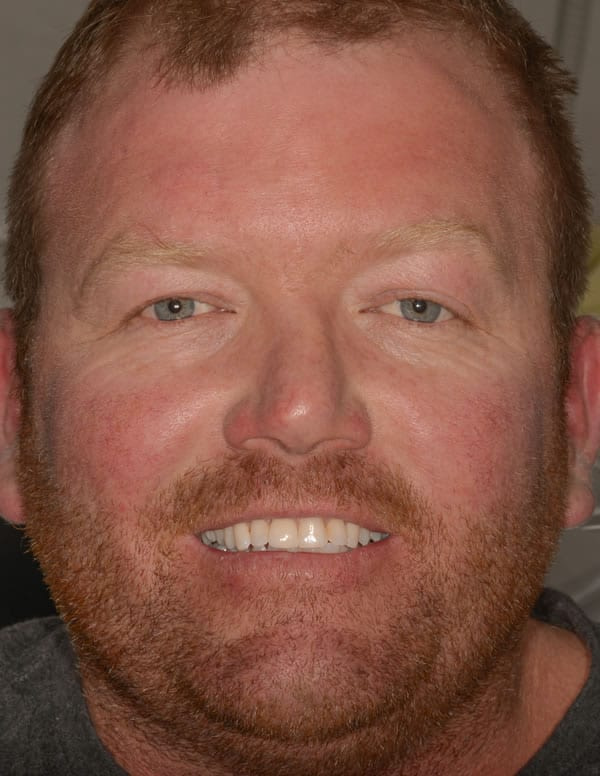 Dental Implants Dental Implants | Jacaranda Dental