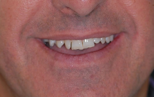 Braces - Fred Braces - Fred | Jacaranda Dental