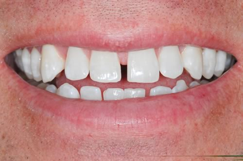Teeth Whitening Teeth Whitening | Jacaranda Dental