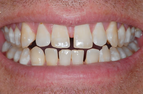 Teeth Whitening Teeth Whitening | Jacaranda Dental