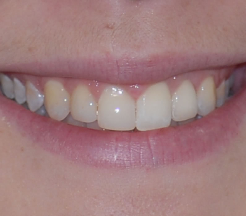 Single Tooth Implant Tooth Implant - Sally | Jacaranda Dental
