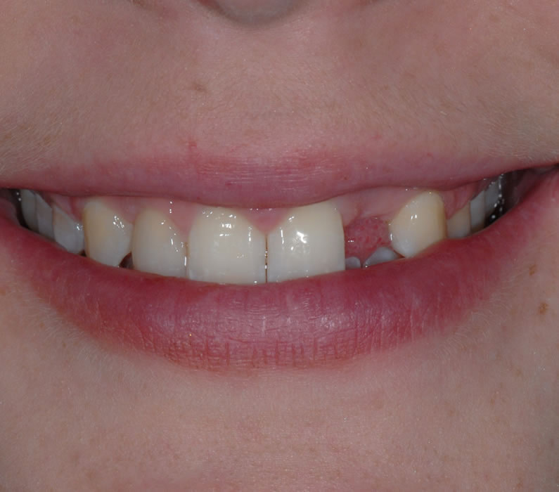 Single Tooth Implant Tooth Implant - Sally | Jacaranda Dental